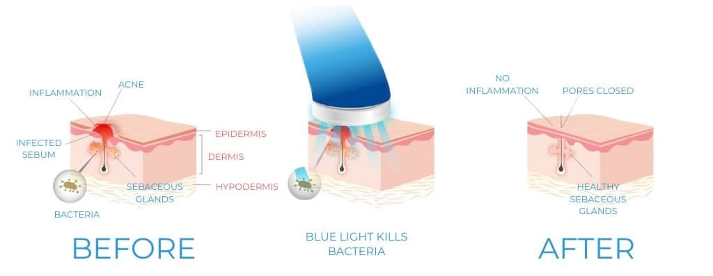 Blue light therapy at home