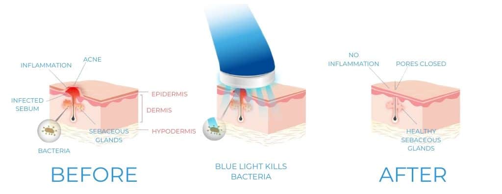 LED Light Therapy Colors MyLEDtherapy LED Light Therapy Color