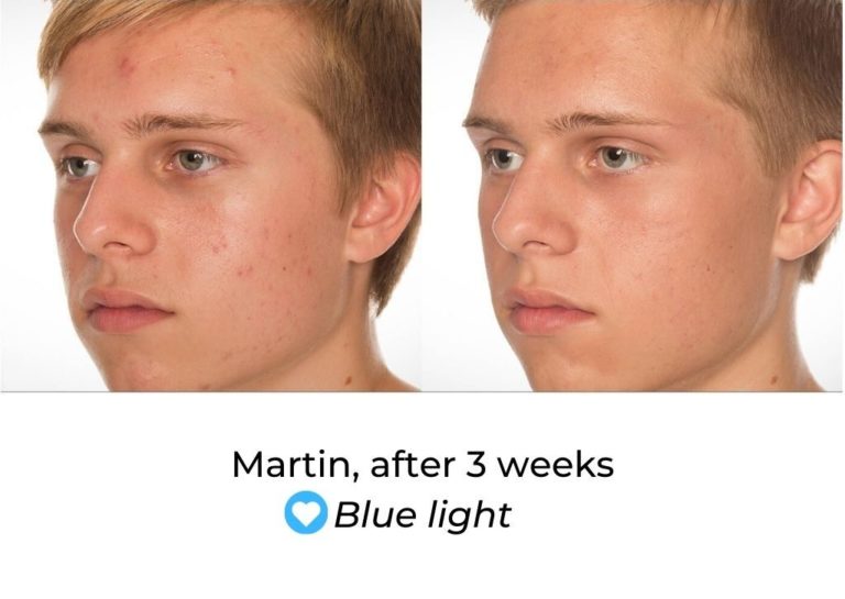 LED Face Mask Before And After MyLEDtherapy LED Light Therapy Before and After LED Face Mask Before And After MyLEDtherapy LED Light Therapy Before and After