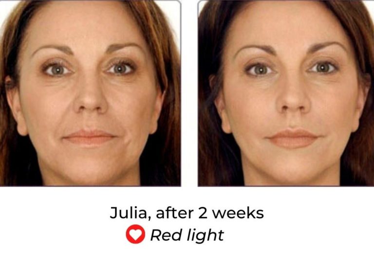 beautypro photon led mask review before and after