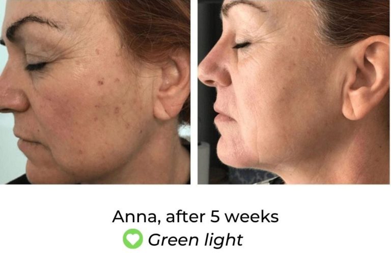 LED Face Mask Before And After MyLEDtherapy LED Light Therapy