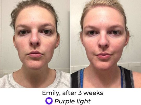 red light face mask before and after