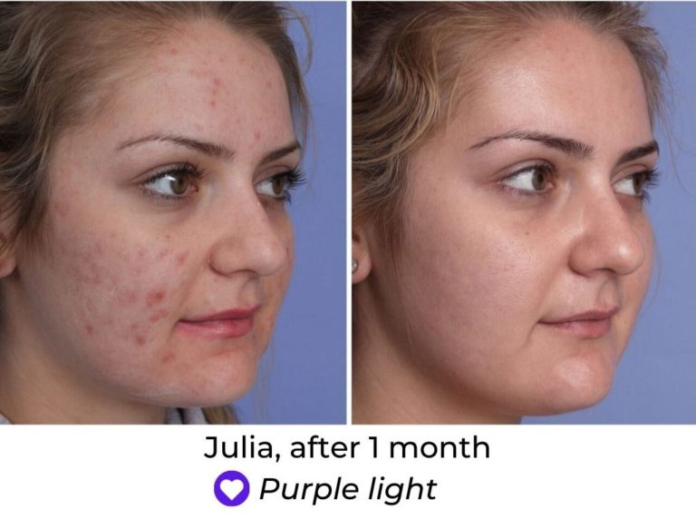 LED Face Mask Before And After MyLEDtherapy LED Light Therapy