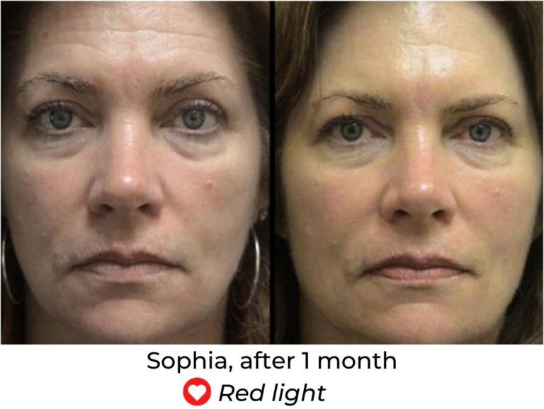 LED Face Mask Before And After - MyLEDtherapy - LED Light Therapy Before and After