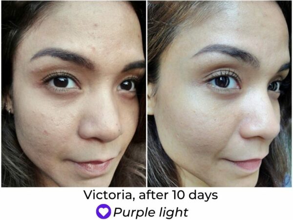 silk n led face mask review before and after