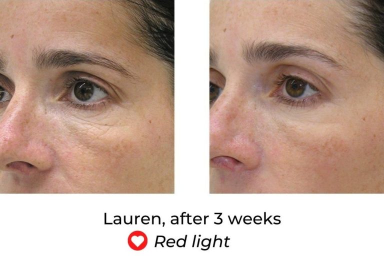 LED Face Mask Before And After - MyLEDtherapy - LED Light Therapy Before and After
