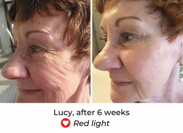 LED Face Mask Before And After  MyLEDtherapy  LED Light Therapy